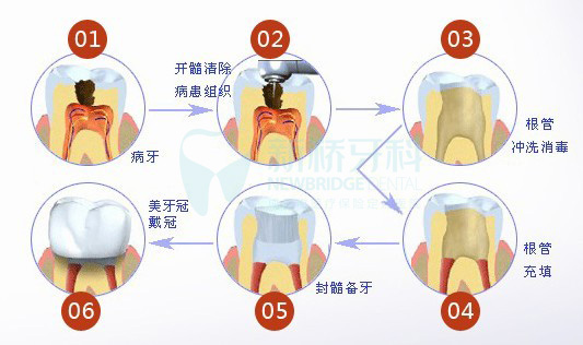 牙齿根管治疗示意图